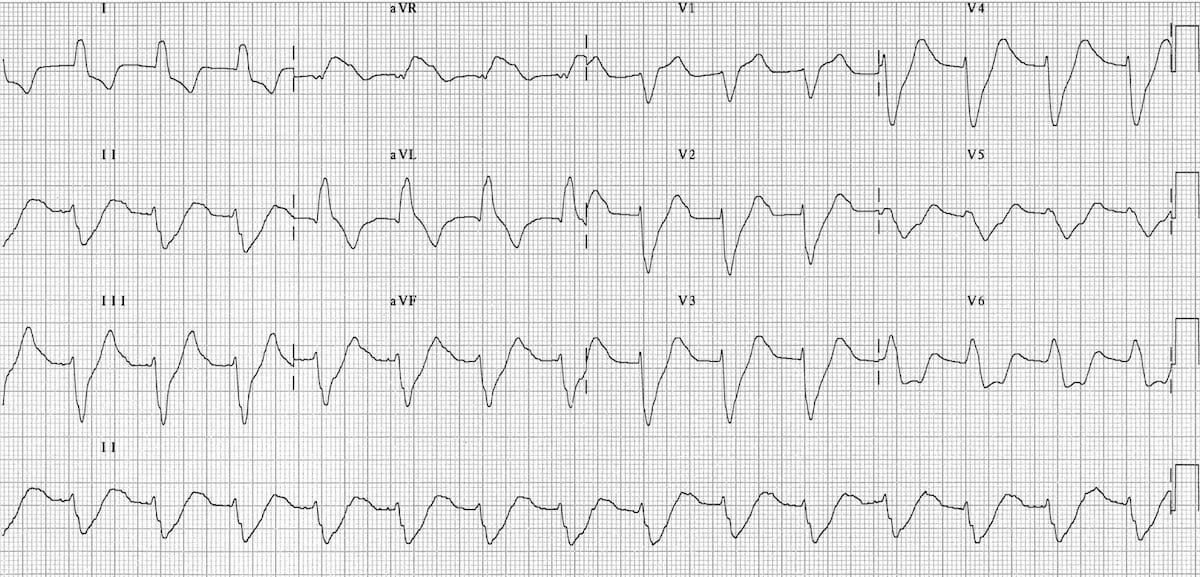 hyperkalemia ecg findings