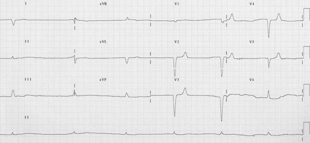 ECG Hyperkalemia junctional bradycardia potassium 8