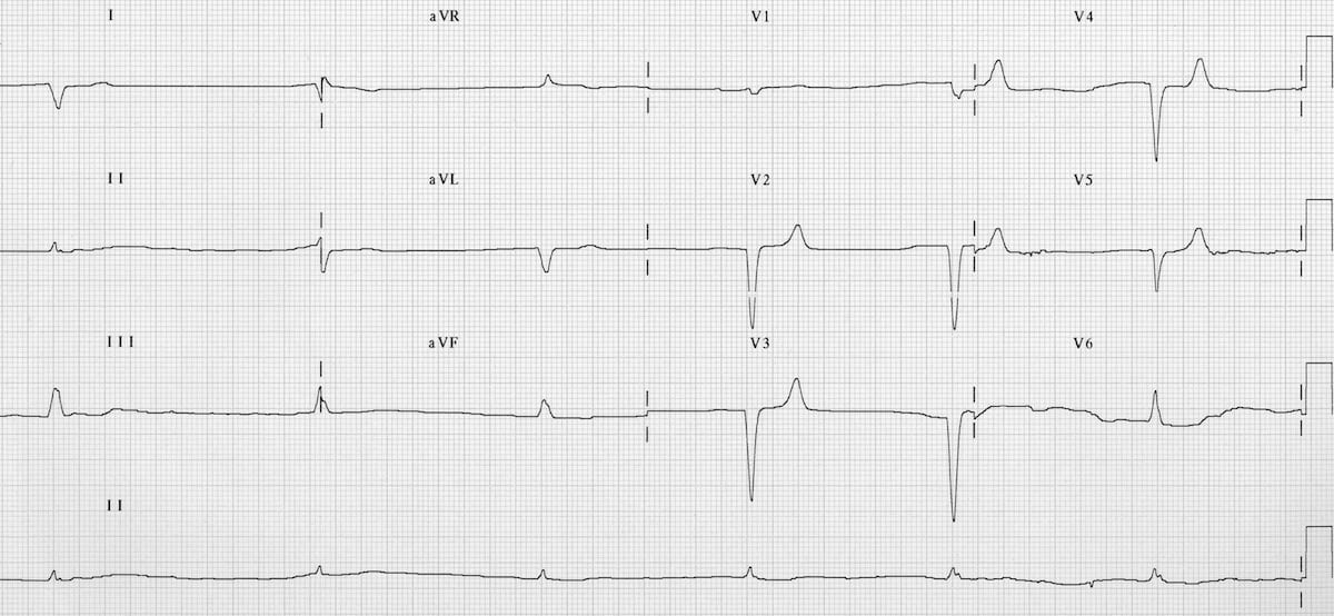 peaked t waves potassium