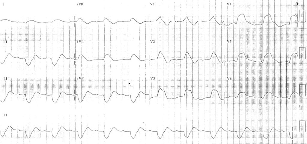 Hyperkalaemia ECG changes • LITFL • ECG Library