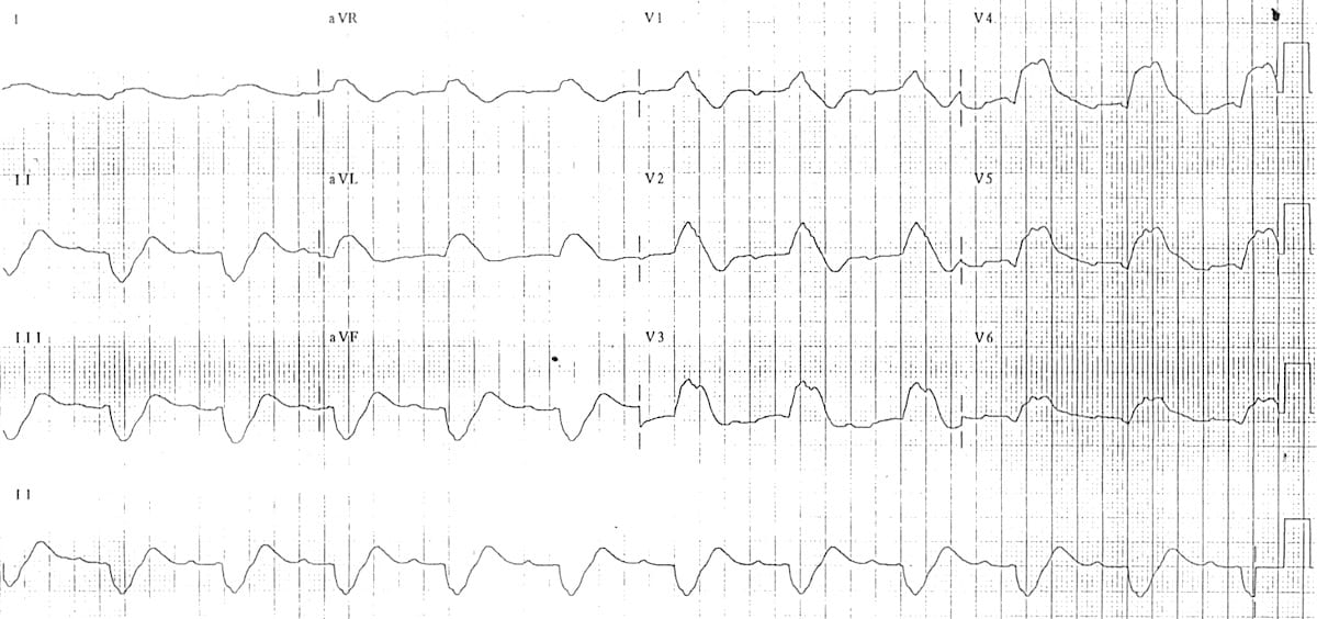 ecg changes in pe