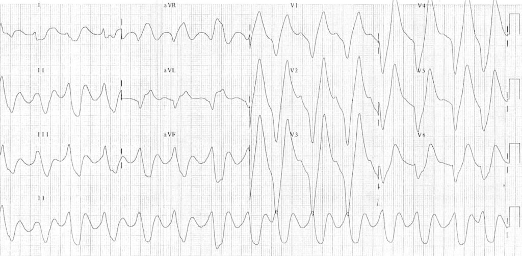 ECG Hyperkalemia rhabdomyolysis