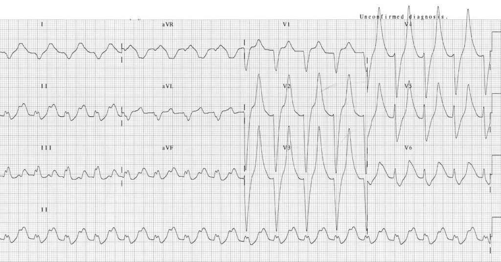 Hyperkalaemia ECG changes • LITFL • ECG Library