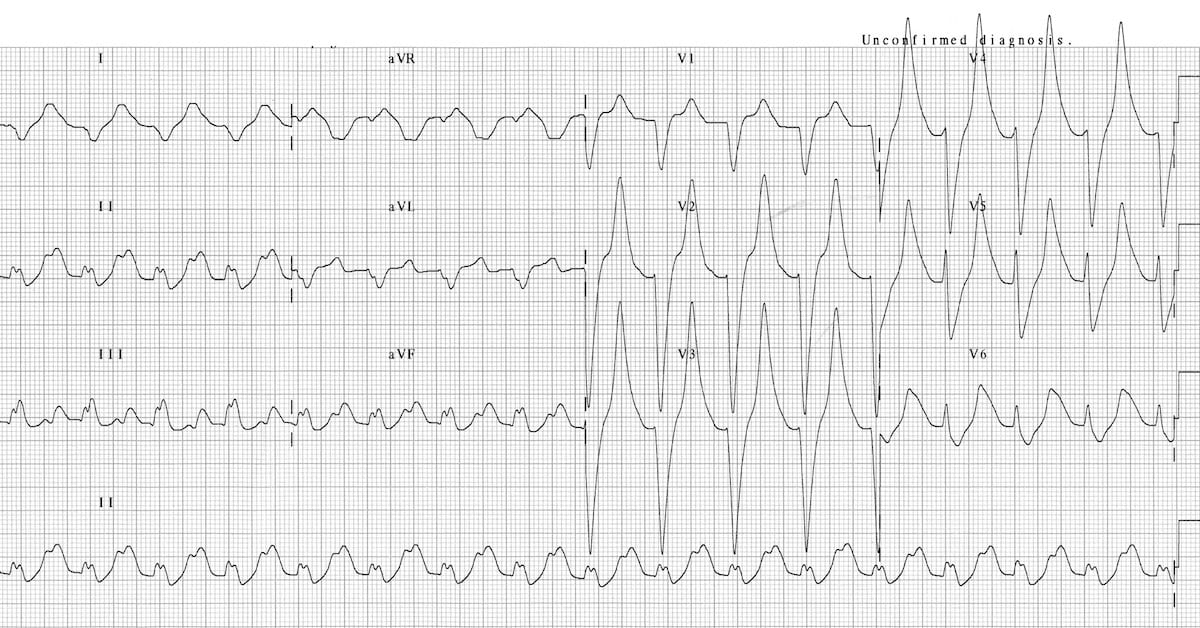 hyperkalemia ekg