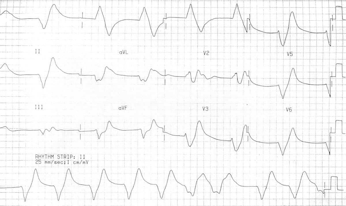 Hyperkalaemia ECG changes • LITFL • ECG Library