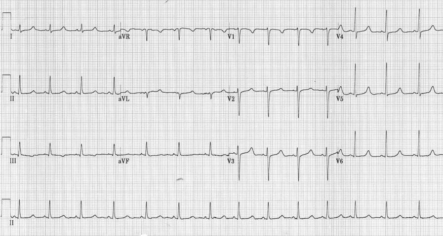 Hypocalcaemia ECG changes • LITFL • ECG Library