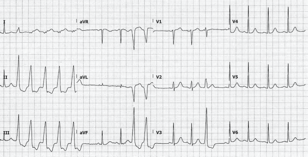 ECG Hypomagnesemia nonsustained ventricular tachycardia 1