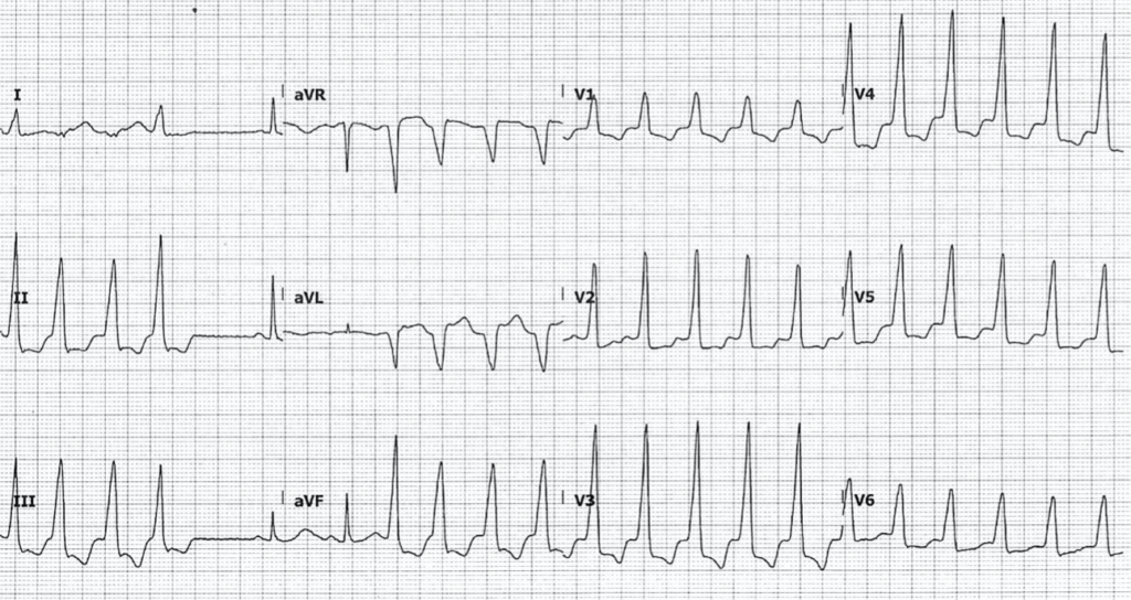 ECG Hypomagnesemia nonsustained ventricular tachycardia 2