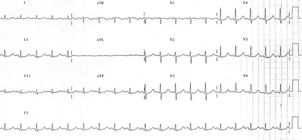 ECG Hypomagnesemia prolonged QT