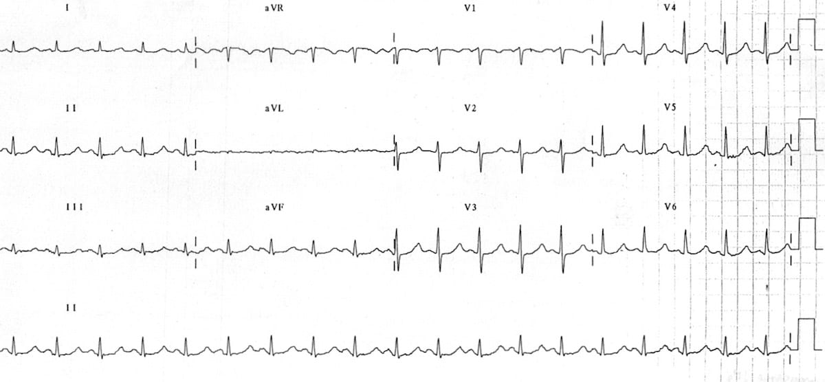 Magnésium : e-cardiogram