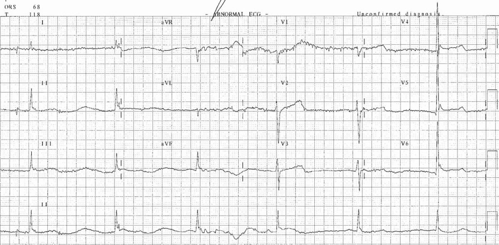 ECG Hypothermia 3