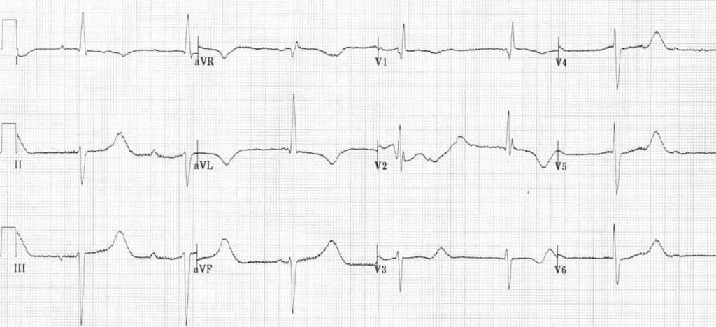 ECG Hypothermia long QT shivering artifact