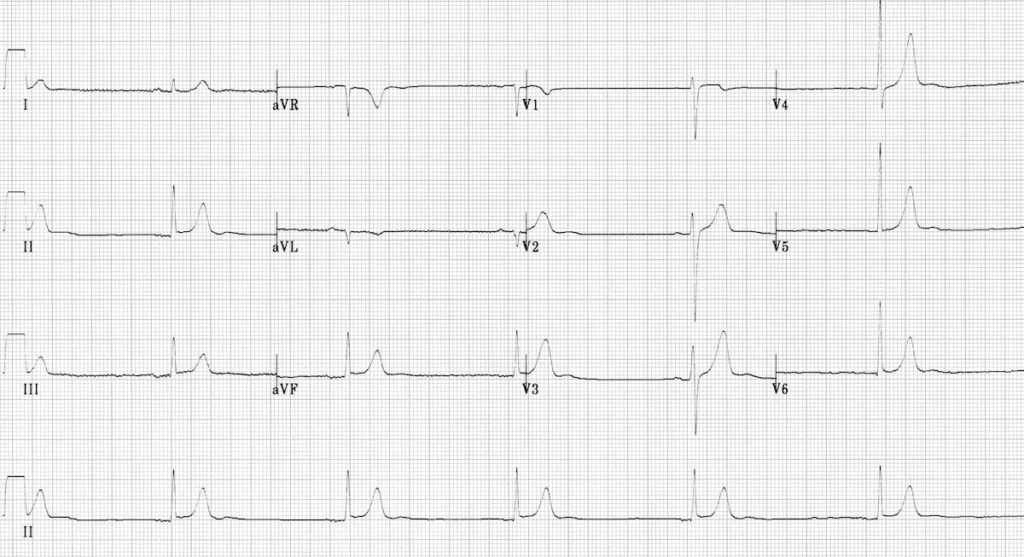 Hypothermia Ecg Changes Litfl Ecg Library Diagnosis