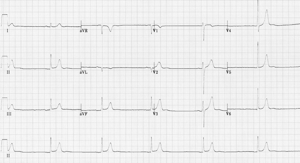 Hypothermia ECG changes • LITFL • ECG Library Diagnosis