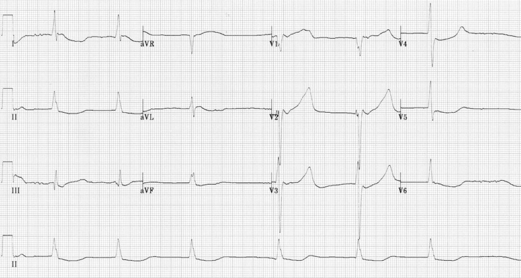 ECG Hypothermia slow atrial fibrillation AF