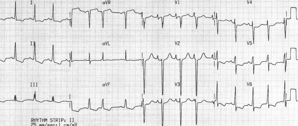 ECG Idiopathic dilated cardiomyopathy Biatrial hypertrophy