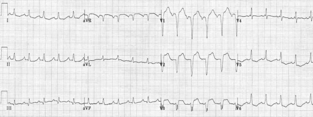 Left Bundle Branch Block (LBBB) (2024)