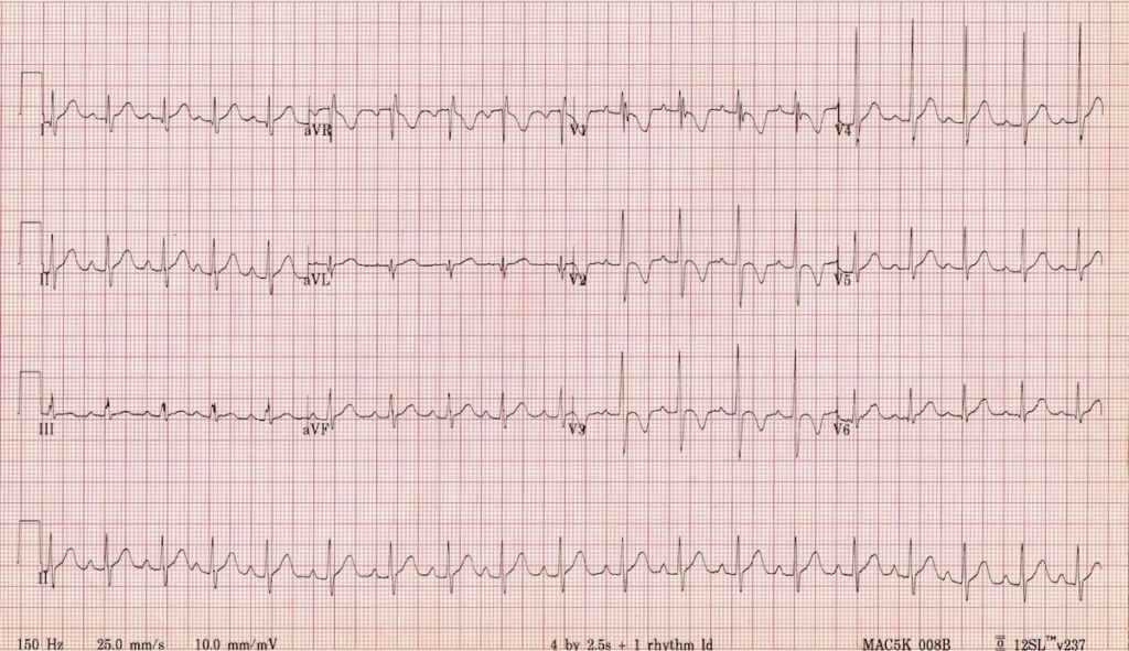 ivcd ecg images