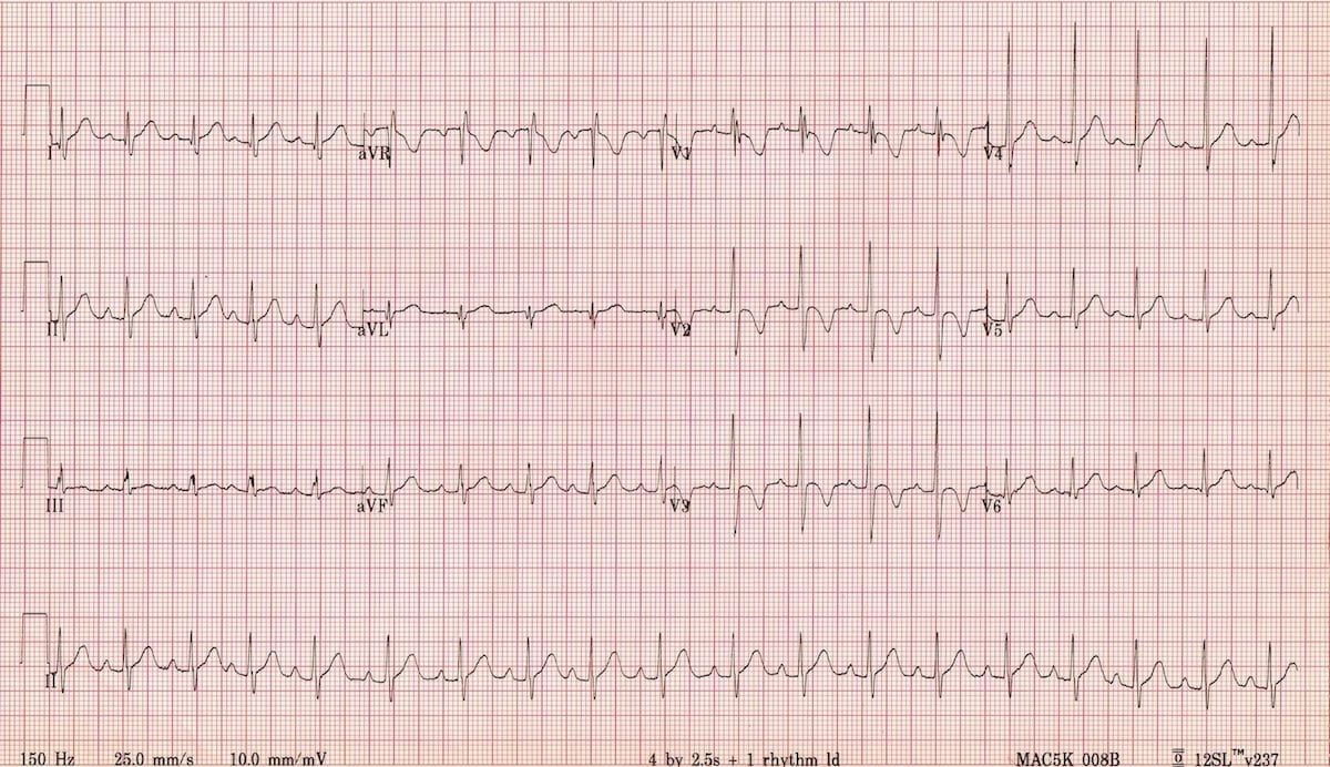 Normal paediatric ECG • LITFL • ECG Library Diagnosis