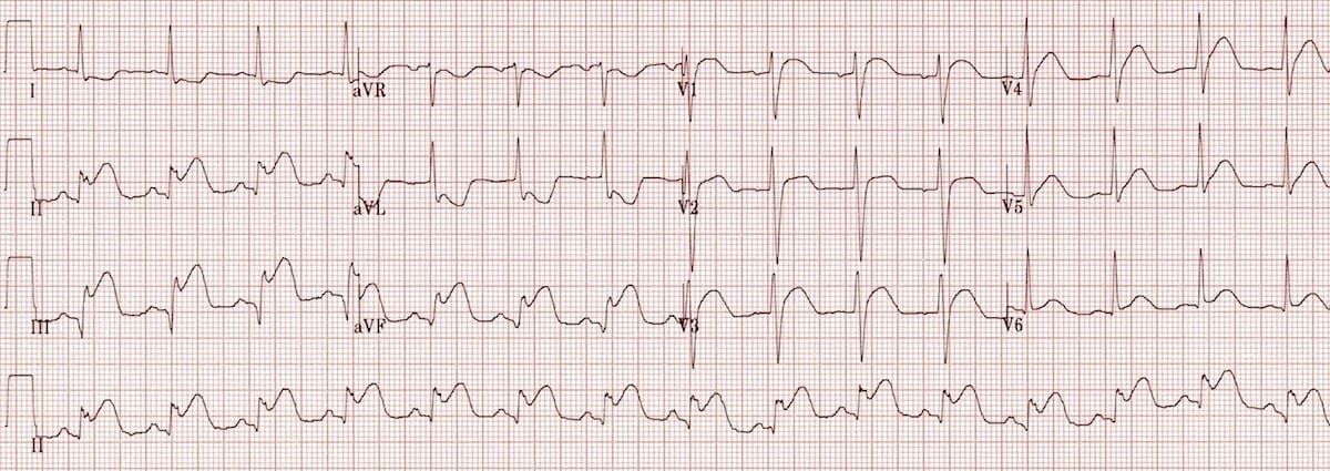 ECG And Arrhythmias UKMLA Guide