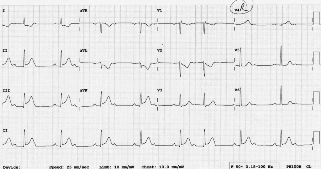 ECG Inferior STEMI RV infarct Wenckebach