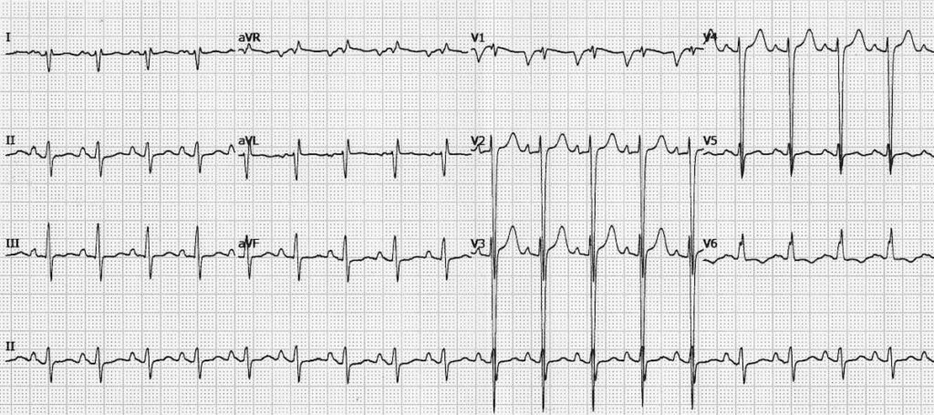 ECG Ischaemic dilated cardiomyopathy 1