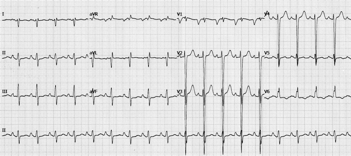 dilated-cardiomyopathy-dcm-litfl-ecg-library-diagnosis