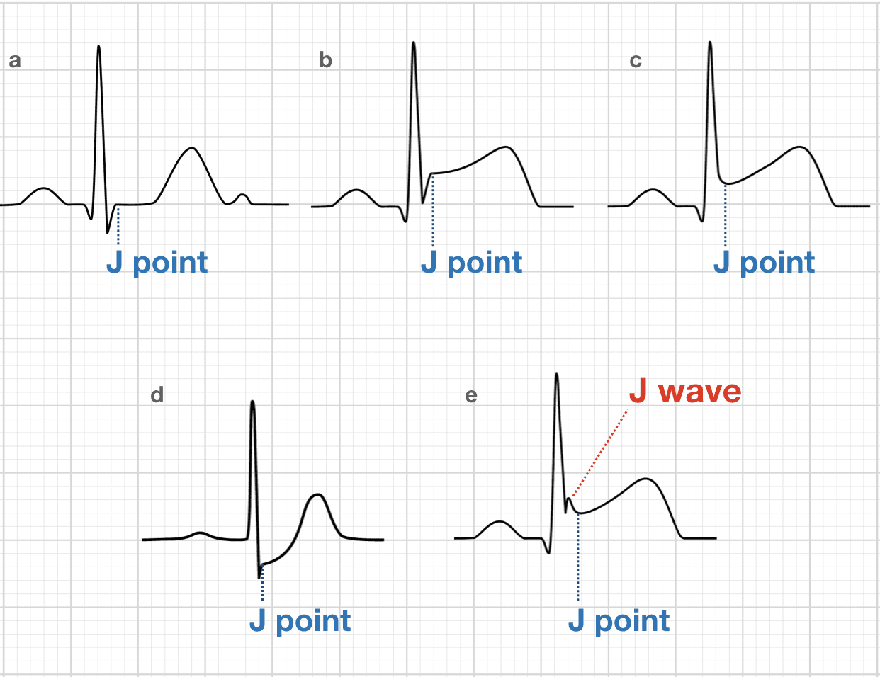 Osborn Wave J Wave Litfl Medical Blog Ecg Library Basics