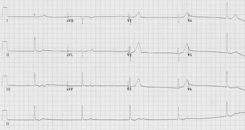 ECG Junctional bradycardia