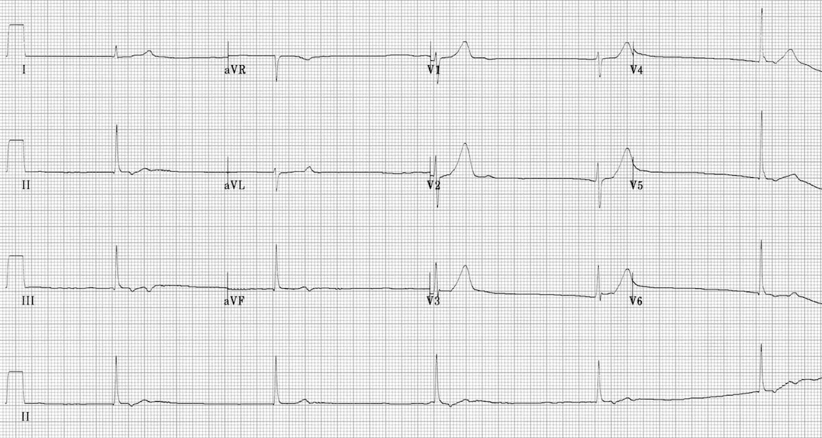 Beta Blocker And Calcium Channel Blocker Toxicity Litfl Ecg Library