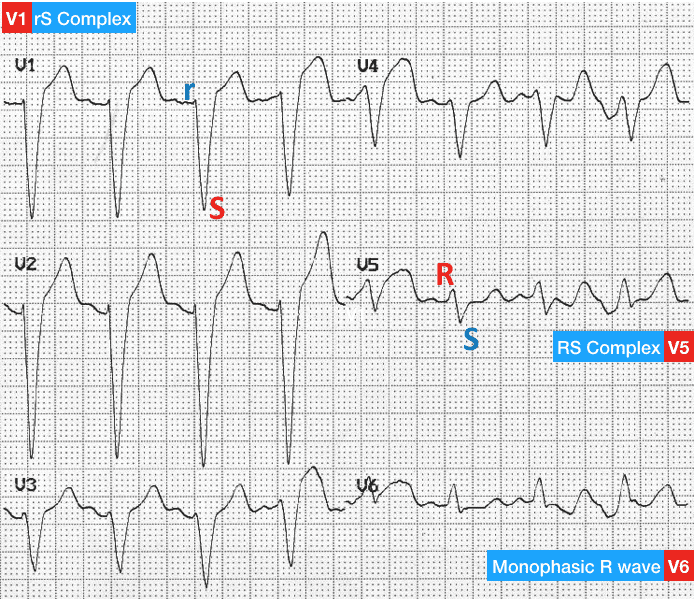 Left Bundle Branch Block (LBBB) • LITFL • ECG Library Diagnosis