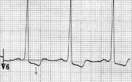 Left Ventricular Hypertrophy (LVH) \u2022 LITFL \u2022 ECG Library Diagnosis