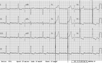 Lvh Normal Variant Left Ventricular Hypertrophy (LVH) • LITFL • ECG Library Diagnosis