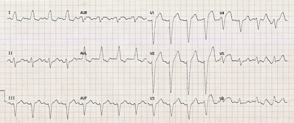 percent of ivcd vs rbbb crt