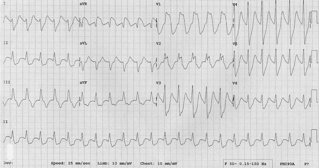 ECG Massive TCA overdose sodium channel toxicity 2