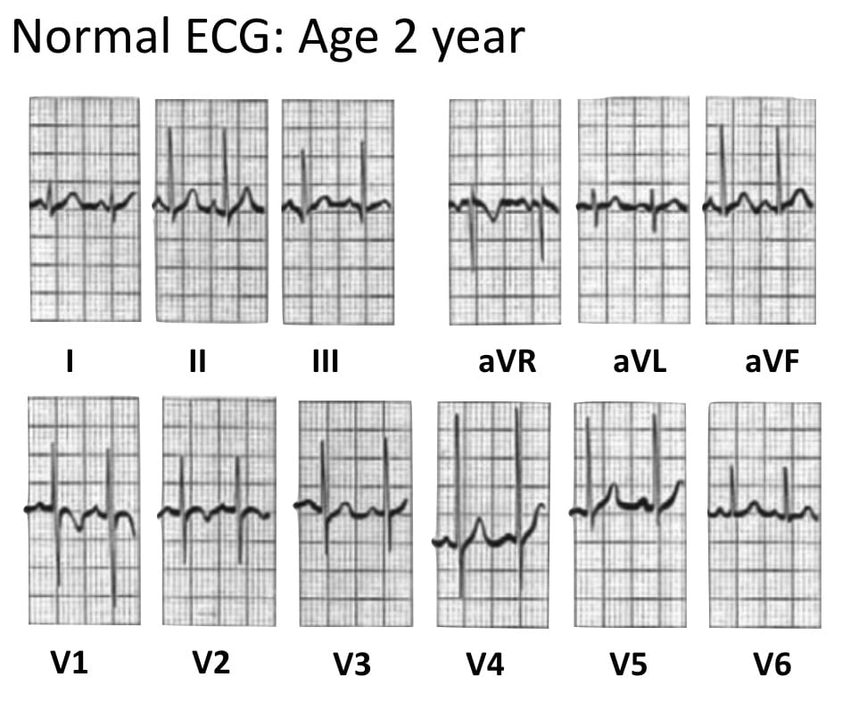 Normal Paediatric ECG LITFL ECG Library Diagnosis Normal Paediatric ECG LITFL ECG Library Diagnosis