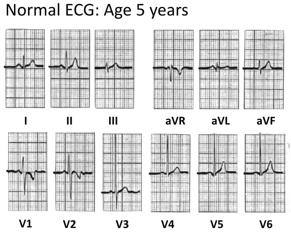 Normal Paediatric ECG LITFL ECG Library Diagnosis