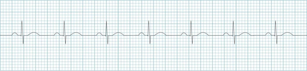 The ST Segment • LITFL • ECG Library Basics