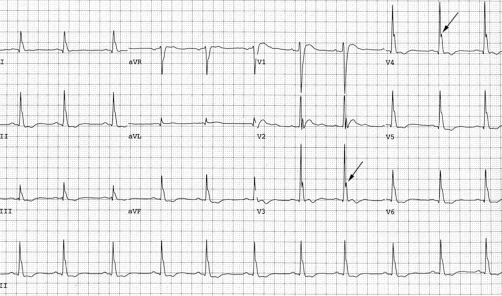 ECG Osborn waves in severe hypercalcaemia