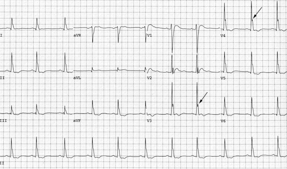 Electrocardiograma De Hipercalcemia