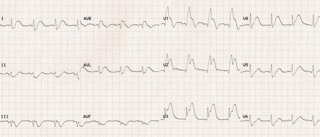 ECG Ostial LAD occlusion (septal STEMI) 2