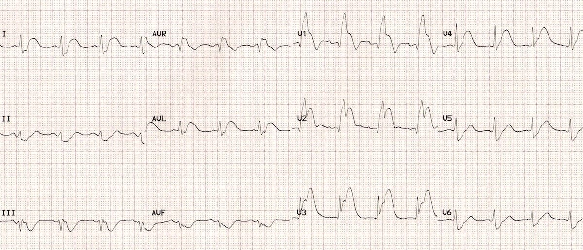 12-Lead STEMI Tool With Corresponding Vessels Chart