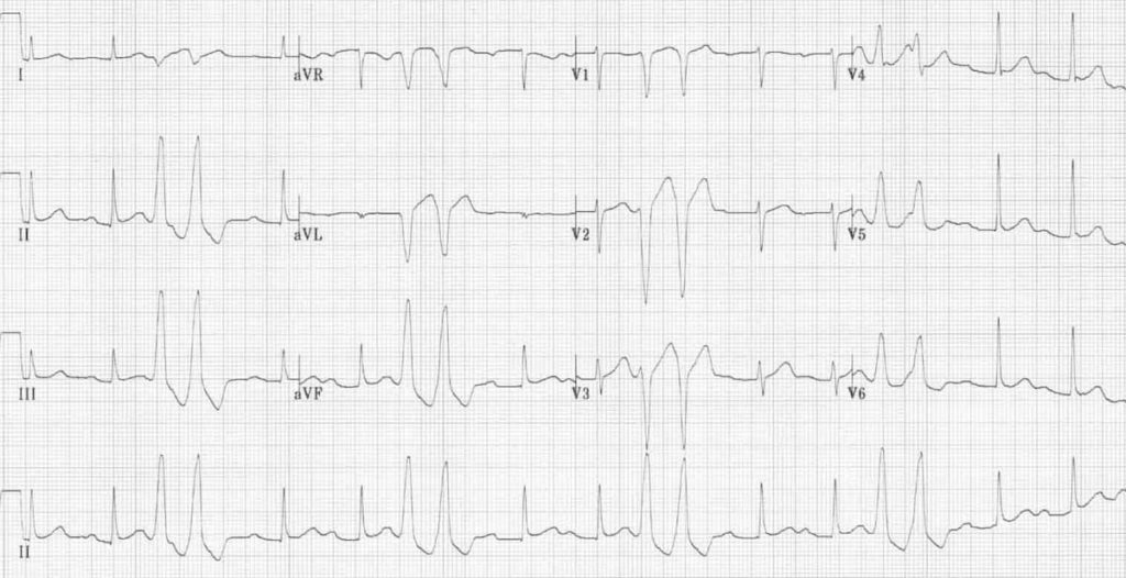 ECG PVC Couplets