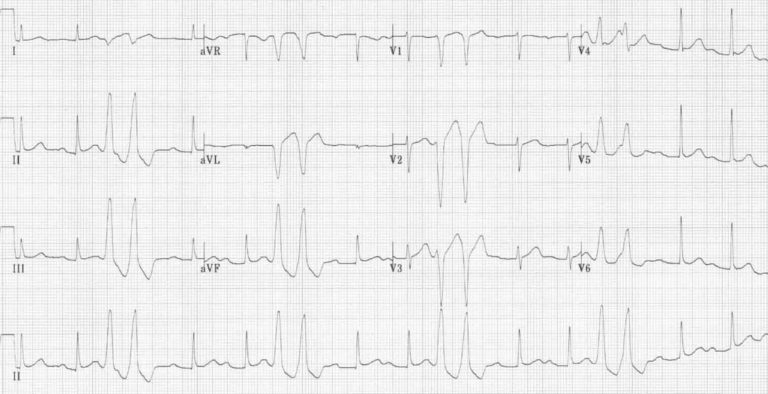 Premature Ventricular Complex (PVC) • LITFL • ECG Library Diagnosis