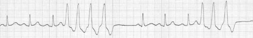 ECG PVC Triplets