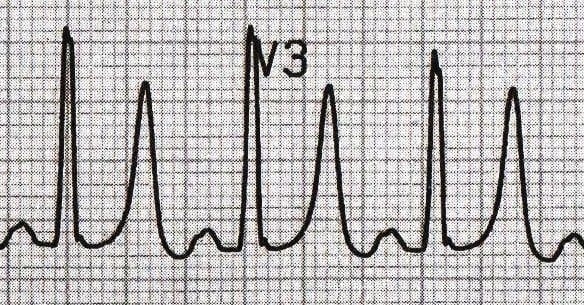 t-wave-litfl-ecg-library-basics