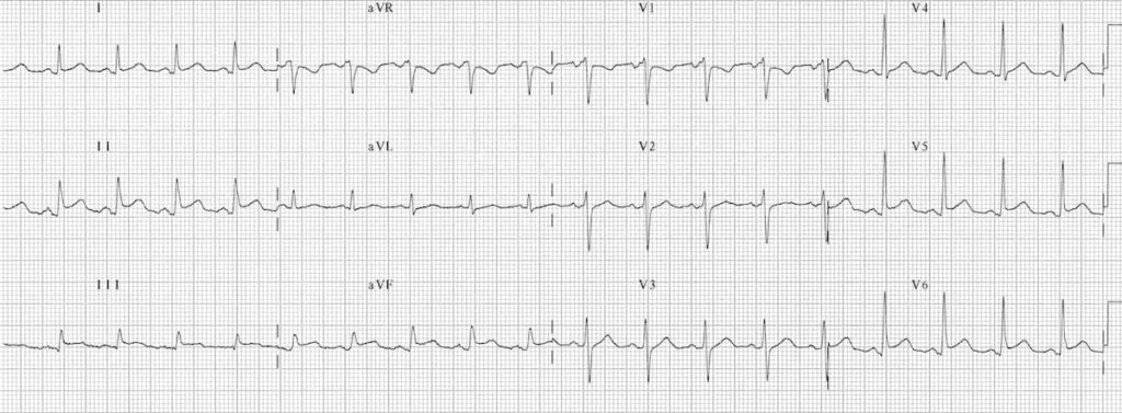 Pericarditis ECG Changes • LITFL • ECG Library Diagnosis