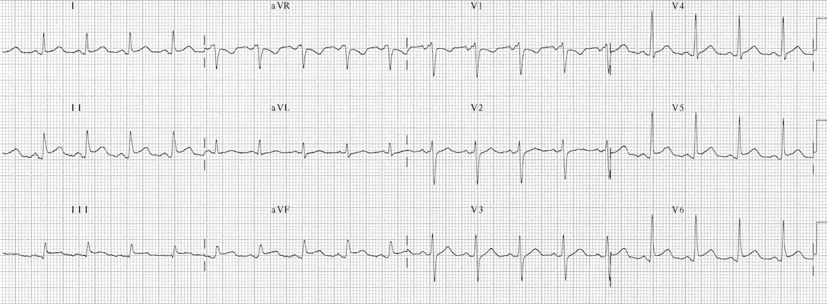 st segment elevation pericarditis