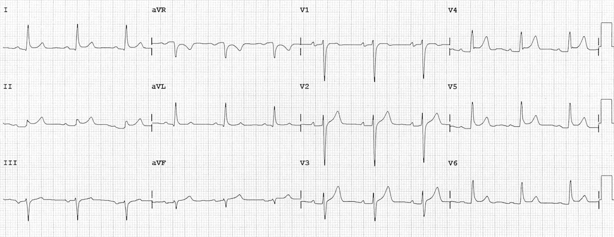 st segment elevation pericarditis