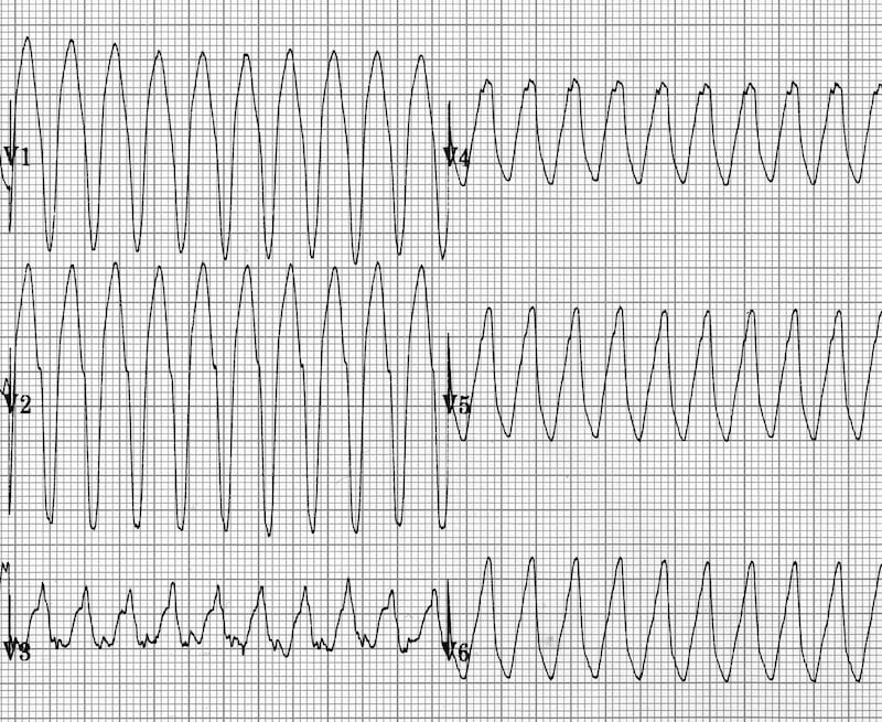 ventricular tachycardia ecg